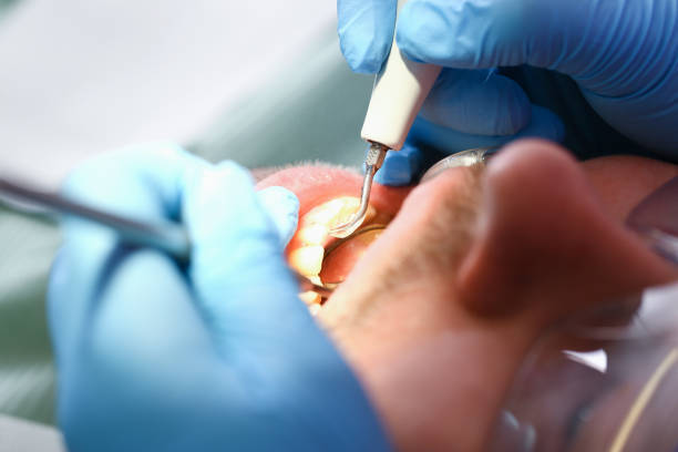 Best Emergency Tooth Extraction in Stonecrest, GA